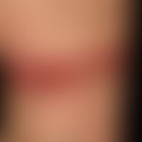 Erythema multiforme: plötzlich aufgetretenes, seit&nbsp;4 Tagen bestehendes, juckendes, dissemini...