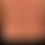 Erythema multiforme: 35-year-old patient with acutely occurring, itchy exanthema, which has been ...
