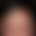 Schwerste&nbsp;kontaktallergische&nbsp;Dermatitis der Kopfhaut auf ein Haarfärbemittel. Massive S...