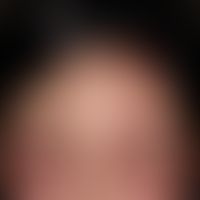 Schwerste&nbsp;kontaktallergische&nbsp;Dermatitis der Kopfhaut auf ein Haarfärbemittel. Massive S...
