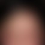 Schwerste&nbsp;kontaktallergische&nbsp;Dermatitis der Kopfhaut auf ein Haarfärbemittel (Parapheny...