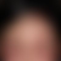 Schwerste&nbsp;kontaktallergische&nbsp;Dermatitis der Kopfhaut auf ein Haarfärbemittel (Parapheny...