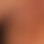 Pyoderma: multiple fresh and older follicular pustules (purulent folliculitis) with evidence of S...