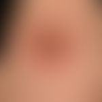 Influenza vaccinations, skin changes:initially blistery, later purulent local reaction after infl...