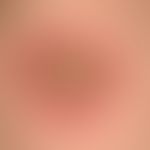 Influenza vaccinations, skin changes:initially blistery, later purulent local reaction after infl...