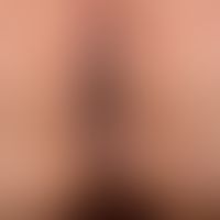 pemphigus chronicus benignus familiaris: laminar (changing course), greasy, white-red, verucose p...