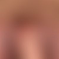 Pemphigus chronicus benignus familiaris: chronic, extremely therapy-resistant, sharply defined, r...