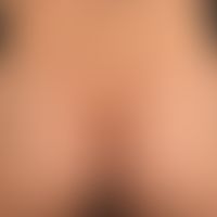 Pemphigus chronicus benignus familiaris: variable clinical picture with multiple, chronic, sympto...
