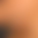 Hirsutismus: androgenabhängiges, männliches Behaarungsmuster (Terminalhaare) mit Betonung der Kin...