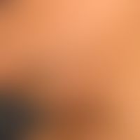 Hirsutismus: androgenabhängiges, männliches Behaarungsmuster (Terminalhaare) mit Betonung der Kin...