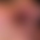 Lymphom kutanes NK/T-Zell-Lymphom nasaler Typ: seit Monaten sich ausdehnender mit rotem Granulati...