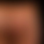 Larva migrans: itchy, still growing, linear, firm, livid red scaly plaques that appeared during a...