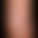 Leishmaniasis&nbsp;kutane: nach einem Urlaub in Tunesien&nbsp;aufgetretene,wenig symptomatische, ...