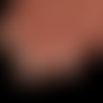 Leukonychie mit Onycholyse: flächige Weißverfärbung der Fignernägel mit Onycholyse des 4. Nagels....