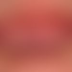 Idiopathic lentigo of the mucosa: solitary symptomless hyperpigmentation that has remained unchan...