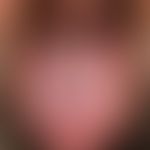 Lingua plicata: ungewöhlich ausgeprägte eworbene Lingua plicata mit unscharf abgegrenzter Leukopl...