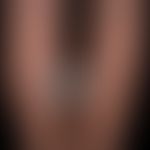 Malformation, vaskuläre: gemischte venös/arterielle Malformation mit umschriebener Weichteilschwe...