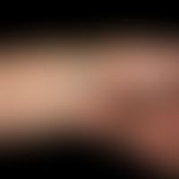 Malformation venöse: rein venöse Malformation ohne kutane Beteiligung.
