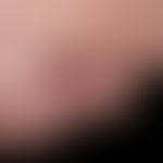 Melanom malignes amelanotisches: seit frühester Kindheit sei ein Pigmentmal an dieser Stelle beka...