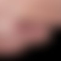 Melanom malignes amelanotisches: seit frühester Kindheit sei ein Pigmentmal an dieser Stelle beka...