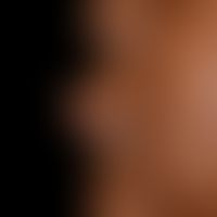 Melkersson-Rosenthal-Syndrom: chronische Verlaufsform mit Cheilitis granulomatosa und Lingua plic...