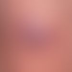 Merkelzell-Karzinom: Detailaufnahme.
