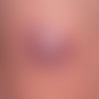 Merkel cell carcinoma: detailed view.
