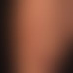 Sprotrichose:&nbsp; lymphogen fortgeleiteten Infektion, mit wenig symptomatischen, längs der Lymp...