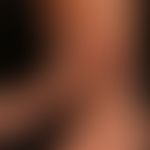 Myxödem prätiabiales: Umschriebene,&nbsp;unscharf begrenzte, gelblich-rötliche,&nbsp; feste,&nbsp...