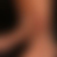 Myxödem prätiabiales: Umschriebene,&nbsp;unscharf begrenzte, gelblich-rötliche,&nbsp; feste,&nbsp...