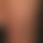 Myxödem prätiabiales: Detailaufnahme.
