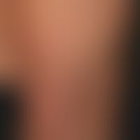 Myxödem prätiabiales: Detailaufnahme.
