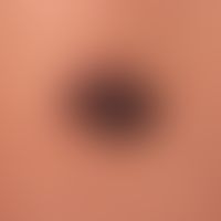 Nevus melanocytic common: melanocytic nevus existingsince earliest childhood. No symptoms. No gro...