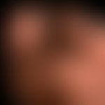 Naevus melanozytärer akraler: &nbsp;völlig sympotmloser, angeborener melanozytärer,&nbsp;Naevus, ...