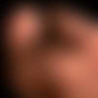 Naevus melanozytärer akraler: &nbsp;völlig sympotmloser, angeborener melanozytärer,&nbsp;Naevus, ...