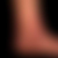 Teleangiektasie-Syndrom naevoides: Seit vielen Jahren bestehende, unscharf begrenzte Rötung aus f...