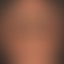 Netherton syndrome: clinical picture already manifested in childhood with the formation of large,...