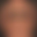 Netherton syndrome: clinical picture already manifested in childhood with the formation of large,...