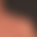Netherton syndrome: close-up.
