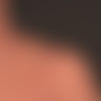 Netherton Syndrom: Detailaufnahme. Deutliche&nbsp;Lichenifikation an hals und Halsansatz.&nbsp;
