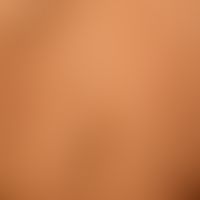 Typ I Neurofibromatose, peripherer Typ oder klassische kutane Form. Zahlreiche tiefliegende weich...