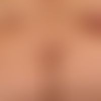 Type I Neurofibromatosis (peripheral type): Numerous soft papules and nodules; multiple smaller a...