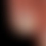 Partielle idiopathische Onycholyse bei gleichzeitig vorhandener Leukonychie.
