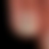 Partielle idiopathische Onycholyse bei gleichzeitig vorhandener Leukonychie.
