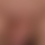 Papillomatosis cutis lymphostatica: chronische Lymphabflussstörung im Beckenbereich. Papilomatose...
