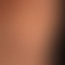 Mondor-Krankheit: plötzlich aufgetretene, strangförmige, etwa 7 cm lange, feste, nur gering schme...