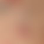 Pityriasis lichenoides chronica: erklärende Detailaufnahme.
