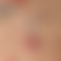 Pityriasis lichenoides chronica: erklärende Detailaufnahme.
