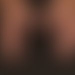 Porphyria cutana tarda: diskreter Befund mit der sich die Erkrankung anfänglich darstellt. Nach b...