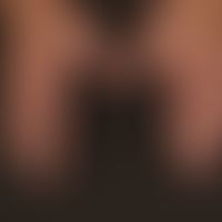 Porphyria cutana tarda: diskreter Befund mit der sich die Erkrankung anfänglich darstellt. Nach b...